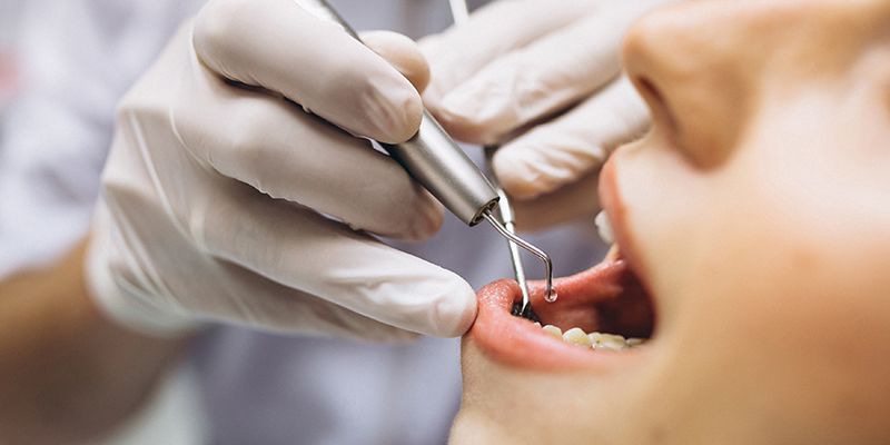 implantes dentales